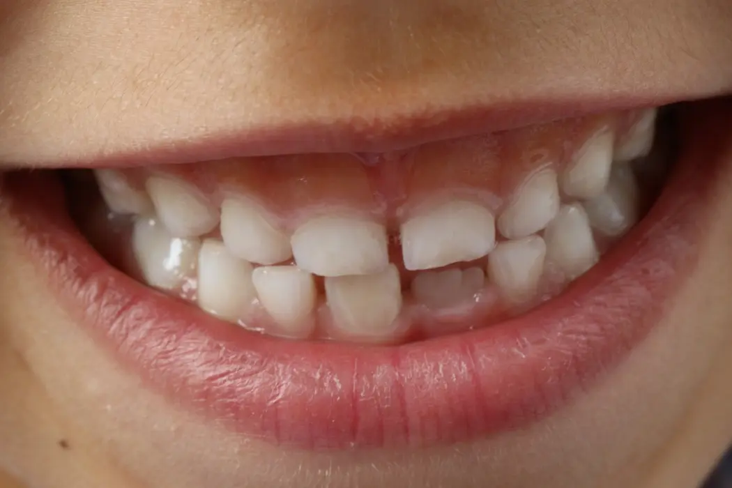 Zgrzytanie zębami u dzieci - skąd się bierze i jak je leczyć?